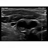 Ультразвуковой аппарат Philips EPIQ CVx 